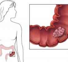 Симптоми на полипи во дебелото црево