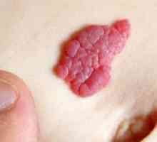 Синдром атипични birthmark (атипична мол синдром)