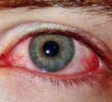 Синдром на црвени очи: Третман