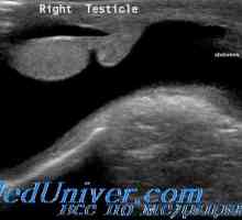Spermatocele и хидроцела кај децата. тестикуларни тумори