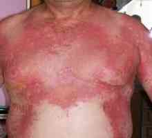 Стафилококна синдром попарена кожа: третман, причини, симптоми, знаци