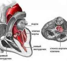 Аортна стеноза, устата, лекување, причини, симптоми, знаци
