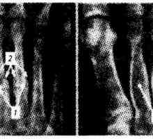 Нозете, глуждовите и долната третина на тибија зрачење и инструмент дијагностика. Оштетување на…