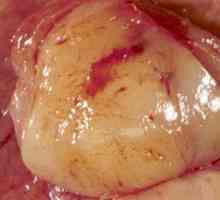 Желудник гастроинтестинални стромални тумори (главен мотив, Ист)