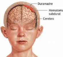 Субдурален хематом мозокот: импликации третман