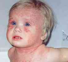 Осип кај дете на dysbacteriosis