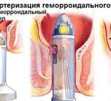Transanal dezarterizatsiya внатрешни хемороиди