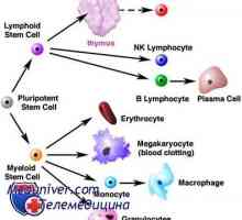 Трансплантација на матични клетки и Hodgkin лимфом (Хочкиновата болест)