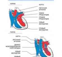 Транспозиција на големите артерии: предизвикува, хирургија, третман, симптоми, знаци