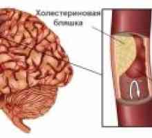 Транзиторен исхемичен напад: симптоми, третманот, последици