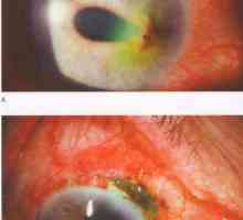 Корнеална траума corneoscleral празнина и рана дехисценција