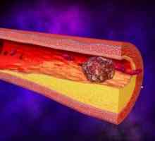 Тромбоза на артериите на горните екстремитети