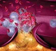 Тромбоза и пулмонална емболија