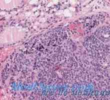 Туберкулоза на тироидната морфологија, патолошка анатомија