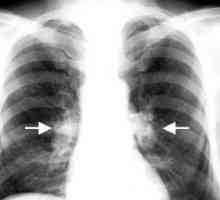 Туберкулоза на интраторакални лимфни јазли: третман, компликации, причините, симптомите