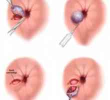 Отстранување на тромбоза на хемороиди