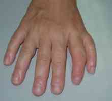 Удвојување на првиот прст (или зрак preaxial полидактилија)