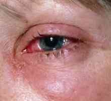Модринки и повреди на очите: третман, прва помош, причини, симптоми, знаци
