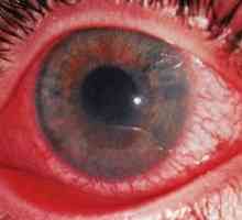 Увеитис око: третман, симптомите, причините, симптомите, дијагноза
