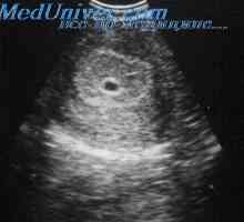Ултразвук во првиот триместар од бременоста. Индикации за transvaginal ултразвук во првиот…