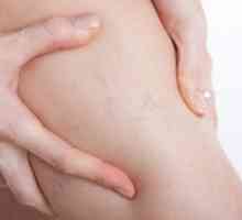 Проширени вени, попуштени вени во текот на бременоста, причини, симптоми, третманот