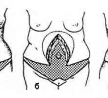 Вертикална abdominoplasty. Карактеристики abdominoplasty ако има лузни на предниот абдоминален ѕид