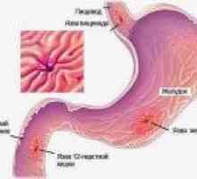 Видови на чир на желудникот: разновидноста и опис