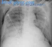 Ефект интраваскуларна воздух во белите дробови. Recompression влијание врз белите дробови