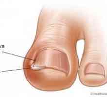 Вродените ноктите на нозете: третман, причини, симптоми, знаци