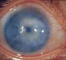 Секундарен глауком око: третман, причини, класификација, симптоми, знаци