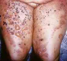 Pemphigus vulgaris: симптоми, третманот, причини