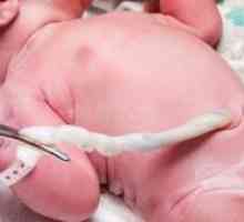 Пролапс на папочната врвца по раѓањето: ефектите, причините