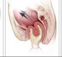 Еверзија на грлото на матката за време на породувањето: третман, причини, симптоми, ефекти