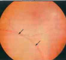 Заболувања на периферијата на мрежницата: дегенеративни retinoschisis