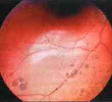 Заболувања на периферијата на ретинална: периферна групирани пигментацијата