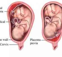 Доцнењето на матката и плацентата од неговите делови