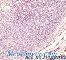 Малигни тироидната жлезда аденом морфологија