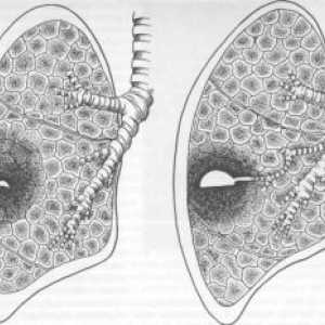 Апсцес на белите дробови: симптоми, третман, дијагноза, компликации причините, симптомите