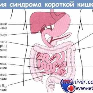 Ефект на синдром на кратко црево (ЗКК) на гастроинтестиналниот тракт
