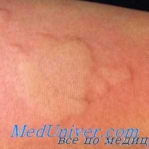 Adrenostimulyatorov алергии. Антихолинергици со алергиски реакции