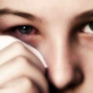 Алергиски конјунктивитис: третман, симптомите, причините, симптомите