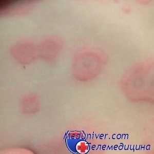 Алергични на сулфонамиди. Stevens-Johnson синдром и токсична епидермална некролиза