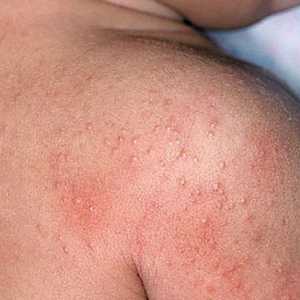 Алергија dysbacteriosis