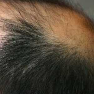 Алопеција коса: Третман, Причини, Симптоми, знаци