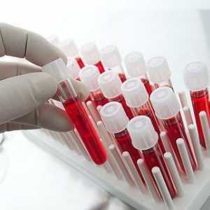 Тестови на крвта за opistorhoz (IFA, биохемија), антитела (АТМ)