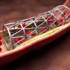 Ангиопластика и коронарна артериска садови
