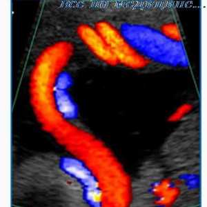 Аномалии на срцето, аортата и пулмоналната багажникот на фетусот. Доплер феталните срцеви аномалии