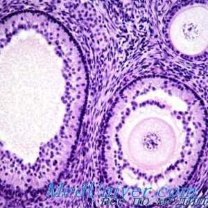 Arrhenoma на јајниците хистологија, патолошка анатомија