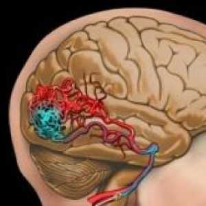Артериовенски малформации на 'рбетниот мозок