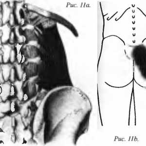 Болки во грбот предизвикани quadratus lumborum